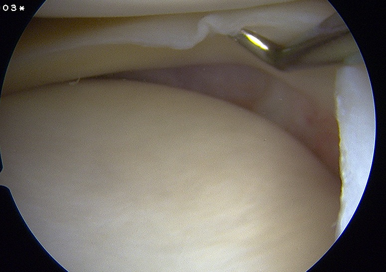 Arthroscopic Lift off of medial meniscus in MCL injury